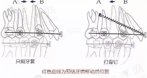 正畸打骨钉术注意事项