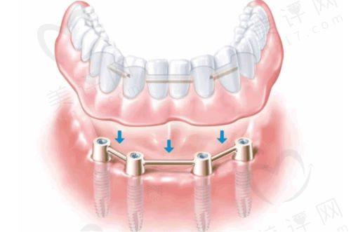All-on-4种植牙