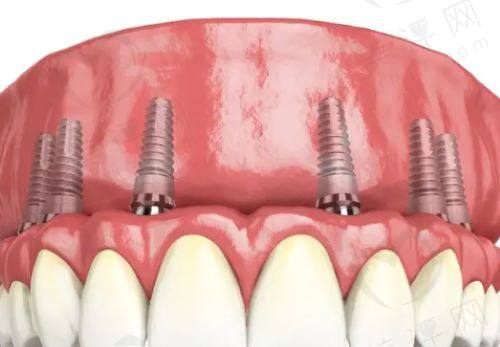 All-on-4种牙对有牙周炎适合吗