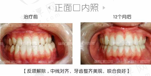 地包天牙齿矫正前后对比