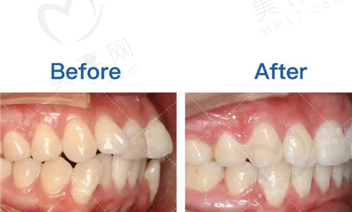 双颌前凸矫正前后咬合对比