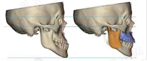 正颌手术老了会怎么样