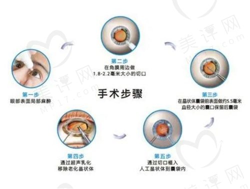 70岁白内障手术风险大不大