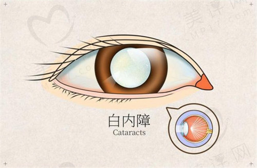 先天性白内障手术早期困难