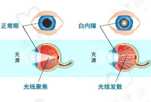 两只眼睛做白内障手术间隔时间多久