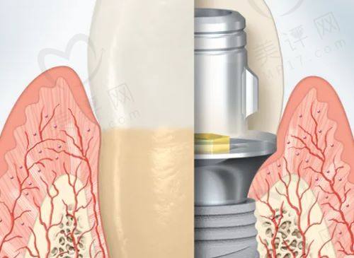 瑞士SIC种植体和诺贝尔种植体适合人群