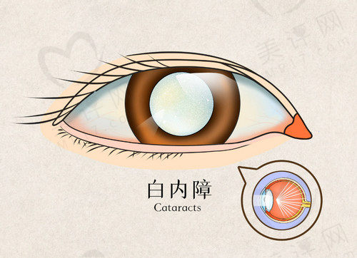 白内障手术的几种方法