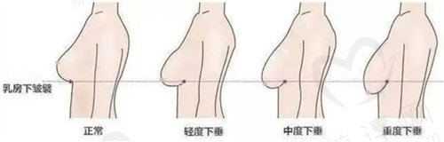 乳房下垂矫正价格多少钱？