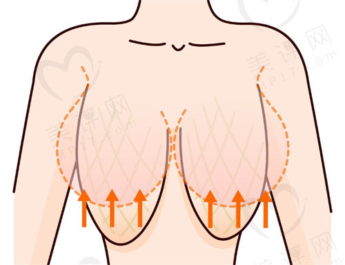 巨乳缩小手术方式有哪些？