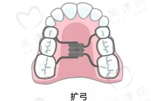 儿童牙齿扩弓治疗是什么？