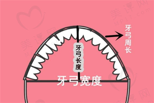 儿童扩弓矫正牙齿的缺点