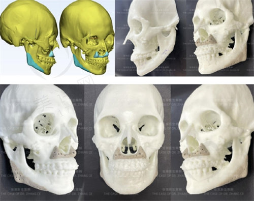 张策医生3D打印PEEK鼻基底