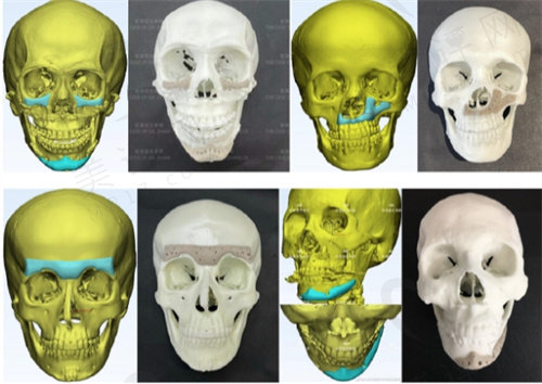 张策医生3d打印鼻基底