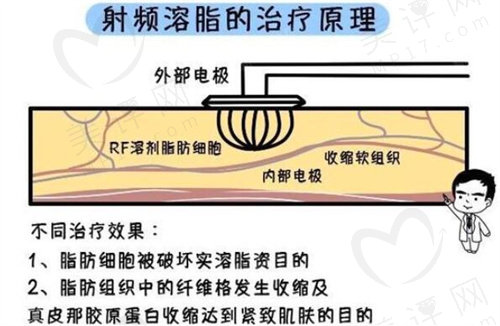 射频溶脂技术原理介绍