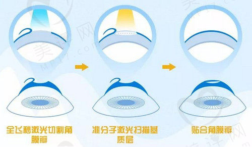 北京医院眼科郭晓萍做近视手术技术娴熟