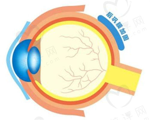 后巩膜加固术的原理