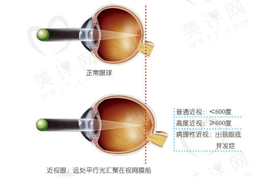 段安丽后巩膜加固术是微创吗