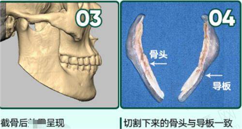 磨骨一年后真实口碑评价