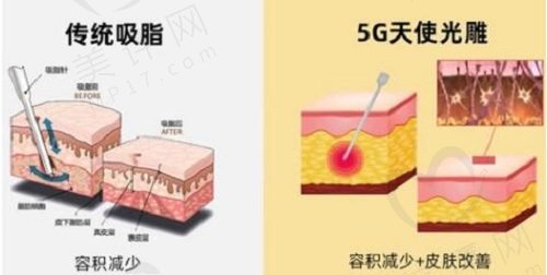 钟伟洪医生擅长吸脂手术，且技术实力突出