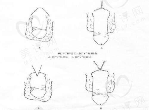 脱细胞异体真皮增粗效 果