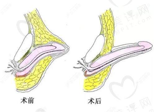 脱细胞异体真皮增粗手术到底有哪些优势呢