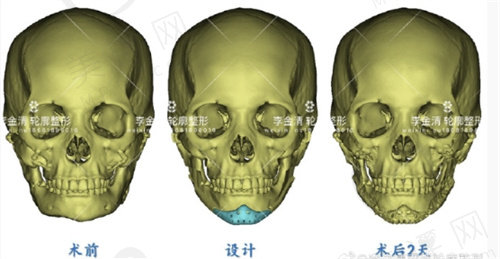 李金清医生磨骨轮廓的例子