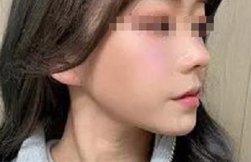 韩国ts整形外科鼻修复