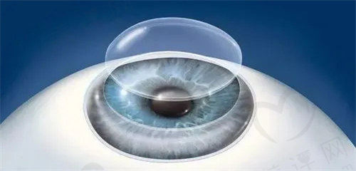 什么是角膜移植手术