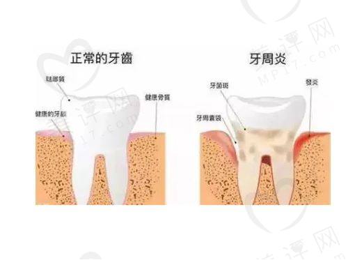 牙龈炎和牙周炎的区别