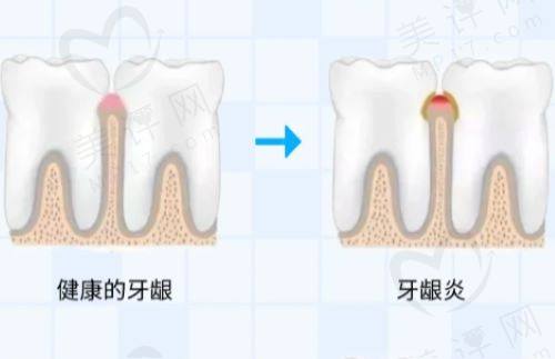 牙龈炎的症状