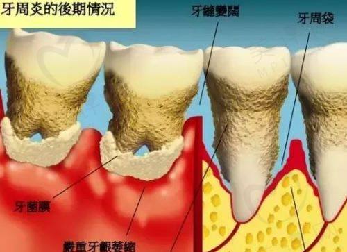 牙周炎的症状