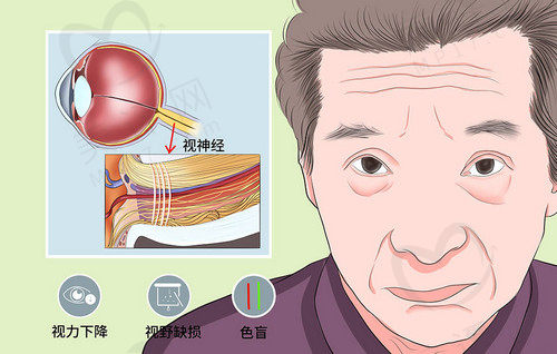 造成视神经萎缩原因