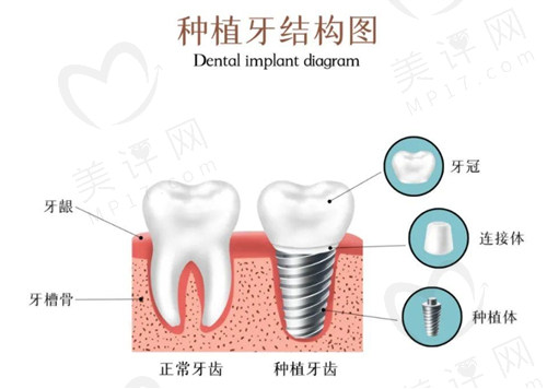种植牙结构图