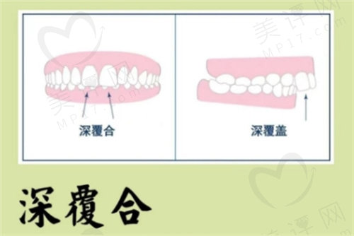 正畸深覆合一定要拔牙吗