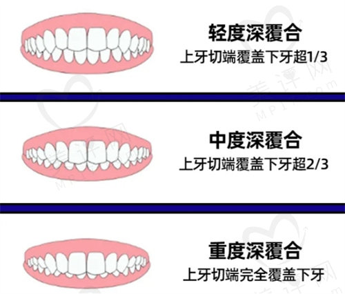 正畸深覆合是什么