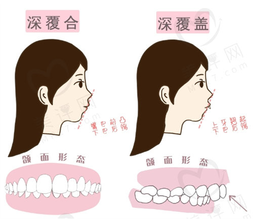 深覆合的危害