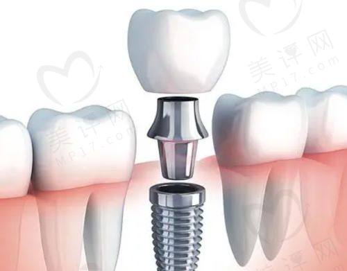 微创种植牙多久可以带牙冠