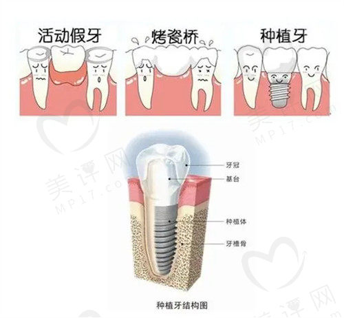 种植牙的结构图