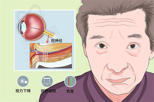 视神经萎缩眼球会有什么变化