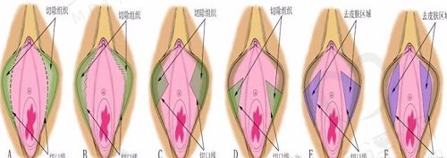 3d紧缩术和传统手术哪个能长久保持