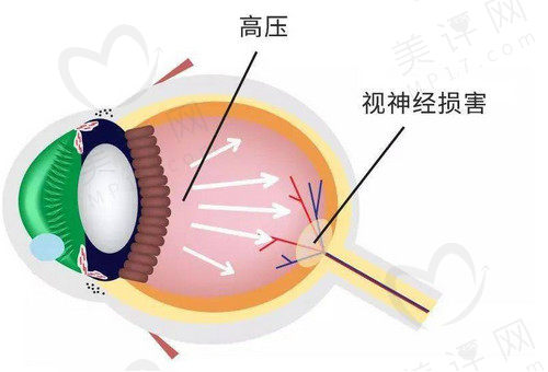 青光眼的症状和表现是什么