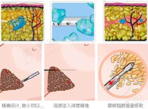 成都王欣吸脂怎么样