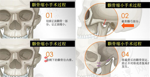 常见的颧骨内推手术风险