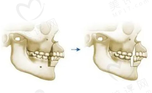 正颌手术怎么做