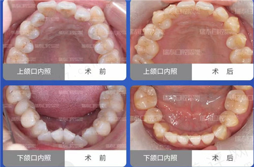 温秀杰正畸前后牙齿对比图