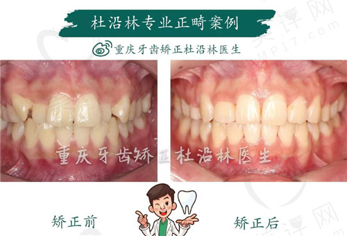 杜沿林正畸前后牙齿对比图