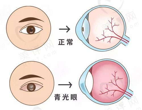 青光眼手术治疗的方法