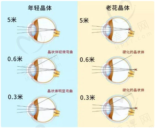 老花眼手术