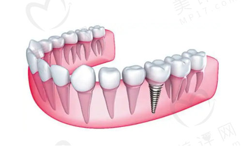 宜昌爱合口腔医院做种植牙怎么样