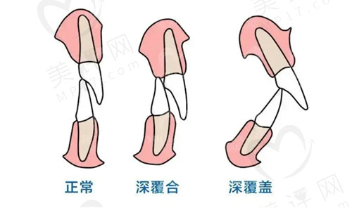 深覆合26岁了还能矫正么？